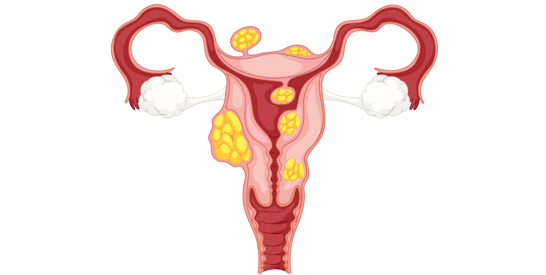 Fibroid Removal Surgery in Baner Pune