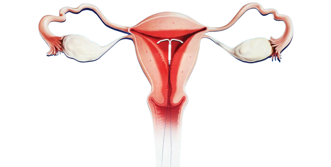 IUD Insertion in Baner Pune
