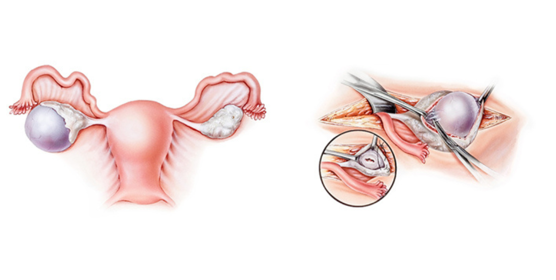 Ovarian Cyst Removal in Baner Pune